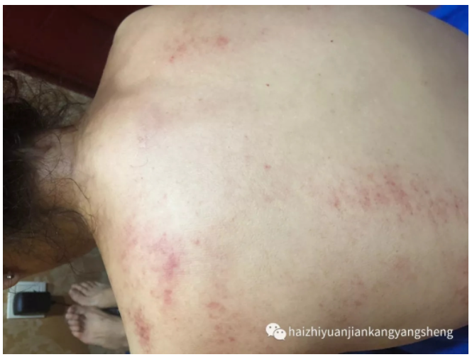 颈椎病调理案例分享：环境论为指导，第三掌骨诊断刮痧辨