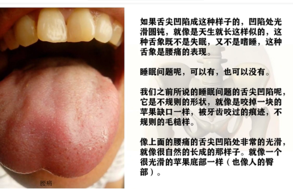 舌形：苹果舌